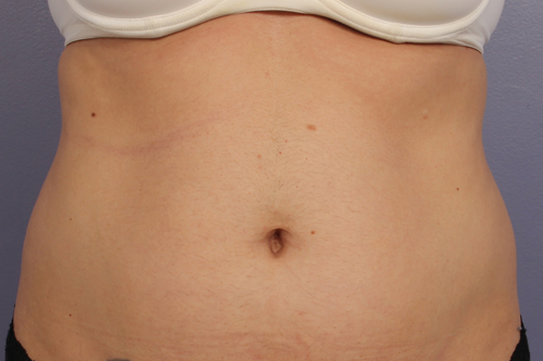 CoolSculpting Before & After Image