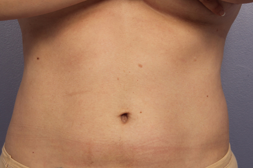 CoolSculpting Before & After Image