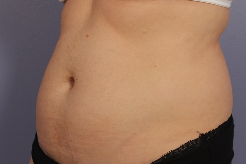 CoolSculpting Before & After Image