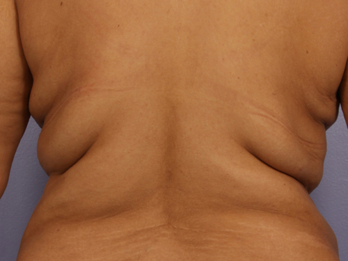 CoolSculpting Before & After Image