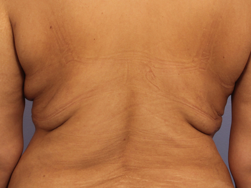 CoolSculpting Before & After Image