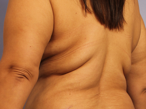 CoolSculpting Before & After Image